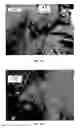 Fig. 33 - Implanted medical device useful for cosmetic surgery