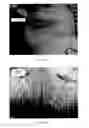 Fig. 34 - Implanted medical device useful for cosmetic surgery