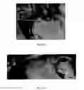 Fig. 40 - Implanted medical device useful for cosmetic surgery