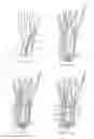 Fig. 30 - System for treating bone fractures