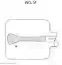 Fig. 10 - Expansion screw bone tamp