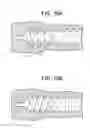 Fig. 16 - Expansion screw bone tamp