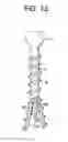 Fig. 19 - Expansion screw bone tamp