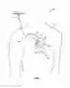 Fig. 02 - Synchronization of electrical stimulation therapy to treat cardiac arrhythmias