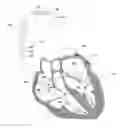 Fig. 01 - Retrograde atrial sensing for identifying sub-threshold atrial pacing