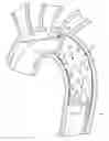 Fig. 01 - Conformable prosthesis delivery system and method for deployment thereof