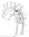 Fig. 11 - Conformable prosthesis delivery system and method for deployment thereof