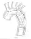 Fig. 12 - Conformable prosthesis delivery system and method for deployment thereof