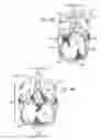 Fig. 09 - PROSTHETIC VALVES FORMED WITH ISOTROPIC FILTER SCREEN LEAFLETS