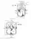 Fig. 09 - METHODS FOR PROSTHETIC VALVES FORMED WITH ISOTROPIC FILTER SCREEN LEAFLETS