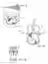 Fig. 12 - KITS WITH PROSTHETIC VALVES FORMED WITH ISOTROPIC FILTER SCREEN LEAFLETS AND METHODS THEREOF