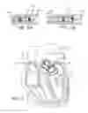Fig. 16 - PROSTHETIC VALVES FORMED WITH SUPPORTING STRUCTURE AND ISOTROPIC FILTER SCREEN LEAFLETS