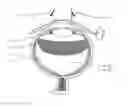 Fig. 01 - Method for burying implant to choroid
