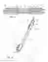 Fig. 06 - Method and apparatus for graft fixation