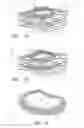 Fig. 02 - Prosthetic intervertebral discs having end plates and an annular capsule