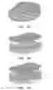 Fig. 03 - Prosthetic intervertebral discs having end plates and an annular capsule