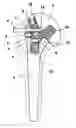 Fig. 01 - Shoulder prosthesis with insert for locking screws