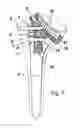 Fig. 06 - Shoulder prosthesis with insert for locking screws
