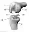 Fig. 01 - Implants for the treatment of osteoarthritis of the knee