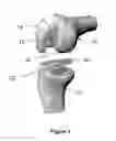 Fig. 02 - Implants for the treatment of osteoarthritis of the knee