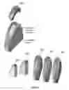 Fig. 04 - Implants for the treatment of osteoarthritis of the knee