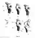 Fig. 07 - Implants for the treatment of osteoarthritis of the knee