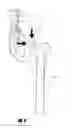 Fig. 03 - Stem for use in joint arthroplasty