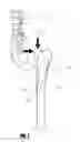 Fig. 05 - Stem for use in joint arthroplasty