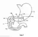 Fig. 04 - Methods and devices to curb appetite and/or reduce food intake
