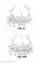 Fig. 37 - Footwear devices with an outer bladder and a foamed plastic internal structure separated by an internal flexibility sipe
