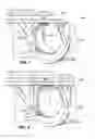 Fig. 02 - Piston wire lock and tool for inserting and removing the same