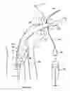 Fig. 17 - Artificial airway