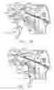 Fig. 36 - Surgical instrument having recording capabilities