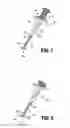 Fig. 06 - Systems and method for forming a coaxial implant