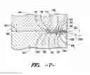 Fig. 06 - AXIAL RETENTION DEVICE FOR TURBINE SYSTEM