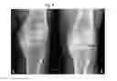 Fig. 06 - COMPOSITION COMPRISING A HAEMATIC COMPONENT AND ITS USE FOR THE TREATMENT OF DEGENERATIVE JOINT DISEASE