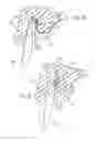 Fig. 05 - Dental prosthesis removal tool