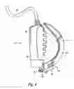 Fig. 06 - System and method of insertion into an oropharyngeal area