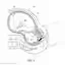 Fig. 03 - Fetal scalp doppler device and system
