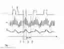 Fig. 02 - APPARATUS AND COMPUTER PROGRAM FOR DETERMINING A PATIENT'S VOLEMIC STATUS REPRESENTED BY CARDIOPULMONARY BLOOD VOLUME