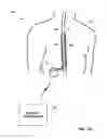 Fig. 03 - Associating therapy adjustments with posture states using a stability timer