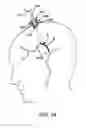 Fig. 05 - Ischemic Stroke Therapy