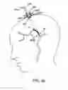 Fig. 06 - Ischemic Stroke Therapy
