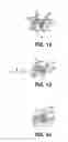 Fig. 10 - Controlled discharge ostomy appliance and shield therefor