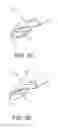 Fig. 06 - Indwelling urinary drainage catheter