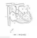 Fig. 02 - HEART VALVE REMODELING