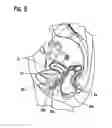 Fig. 07 - INJECTABLE IMPLANTS FOR TISSUE AUGMENTATION AND RESTORATION