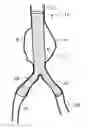 Fig. 01 - Intraluminal polymeric devices for the treatment of aneurysms
