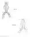 Fig. 03 - Intraluminal polymeric devices for the treatment of aneurysms