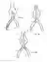 Fig. 04 - Intraluminal polymeric devices for the treatment of aneurysms